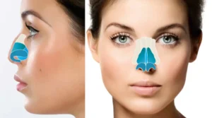 rhinoplasty